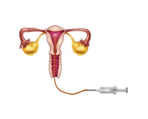 Iui Intrauterine Insemination Treatment In Chennai Dr Fatima